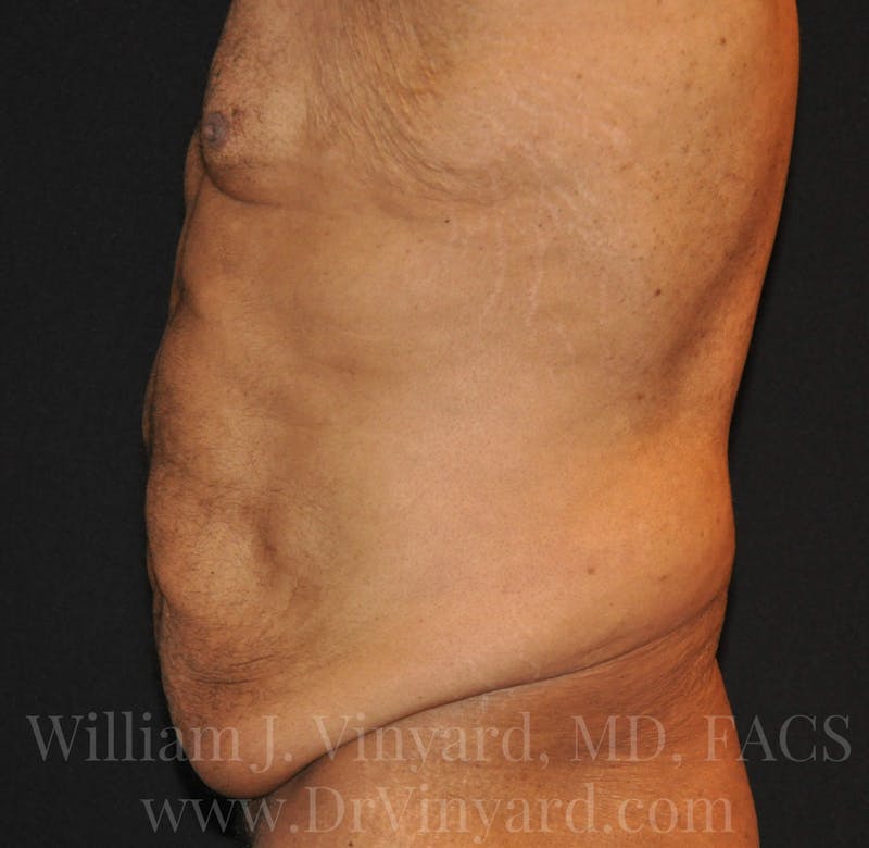 Lower Body Lift Before & After Gallery - Patient 169792926 - Image 9