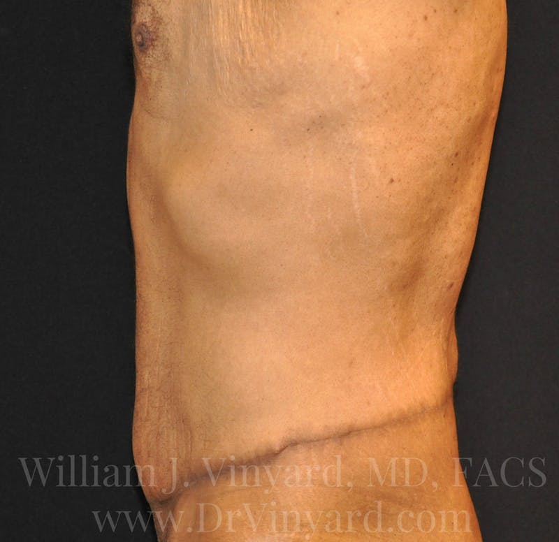 Lower Body Lift Before & After Gallery - Patient 169792926 - Image 10