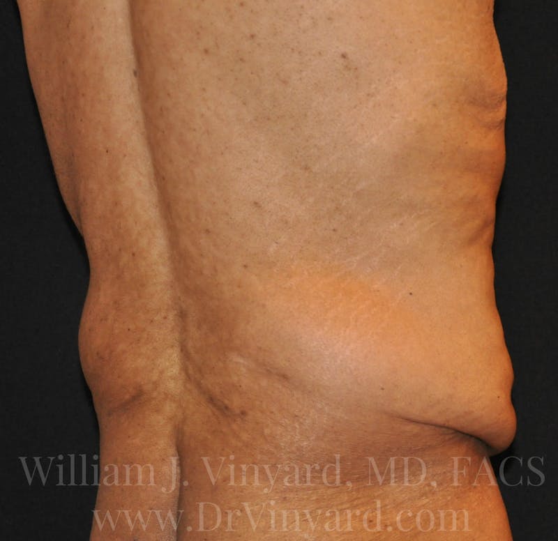 Lower Body Lift Before & After Gallery - Patient 169792926 - Image 11