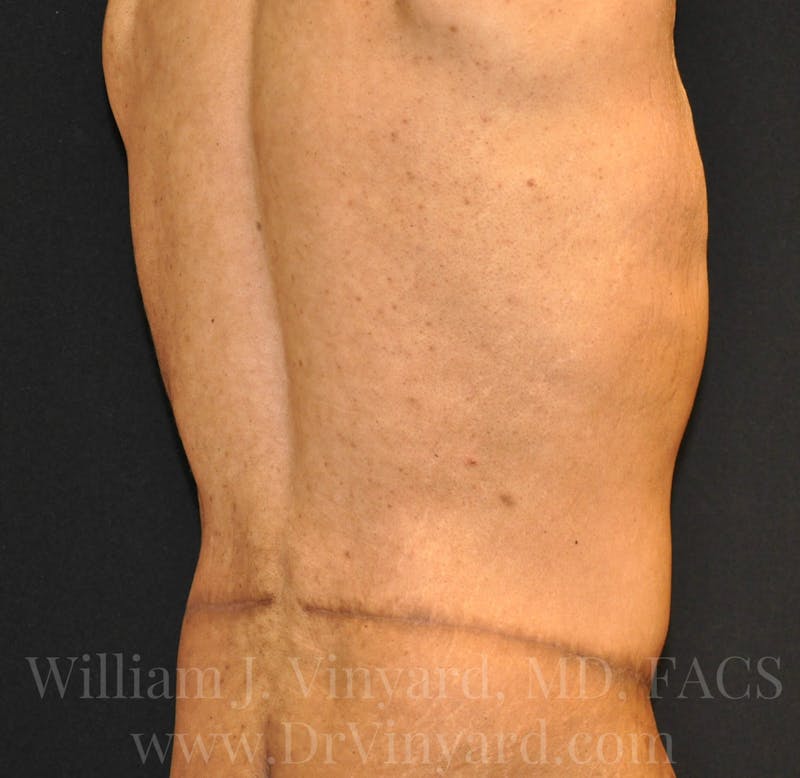 Lower Body Lift Before & After Gallery - Patient 169792926 - Image 12