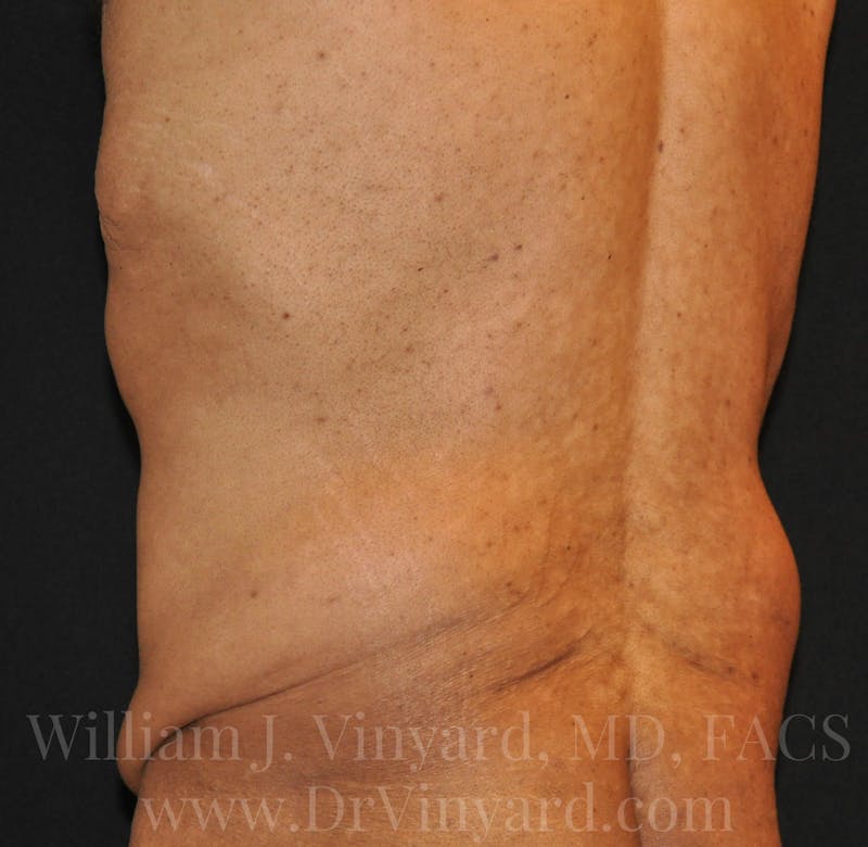 Lower Body Lift Before & After Gallery - Patient 169792926 - Image 13