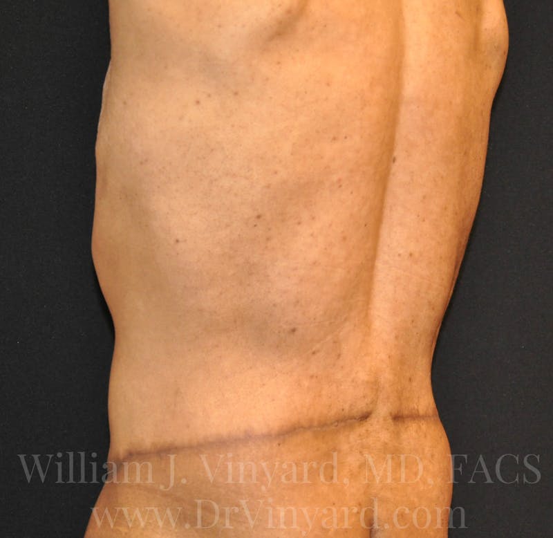 Lower Body Lift Before & After Gallery - Patient 169792926 - Image 14