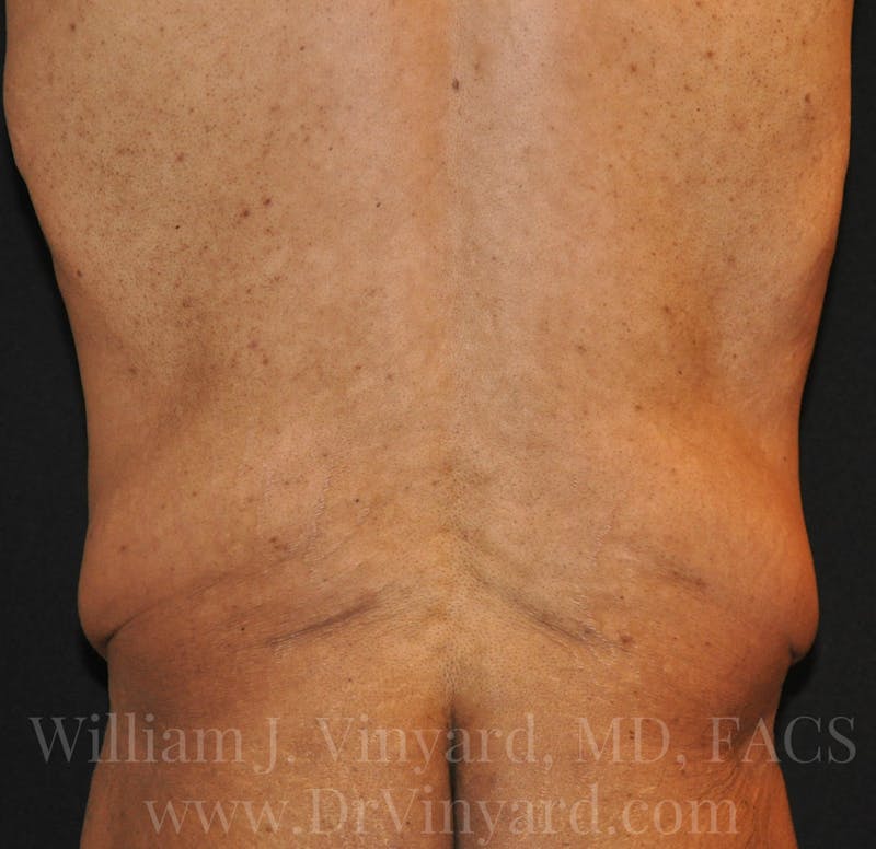 Lower Body Lift Before & After Gallery - Patient 169792926 - Image 15