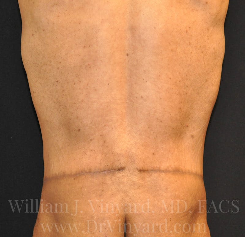 Lower Body Lift Before & After Gallery - Patient 169792926 - Image 16