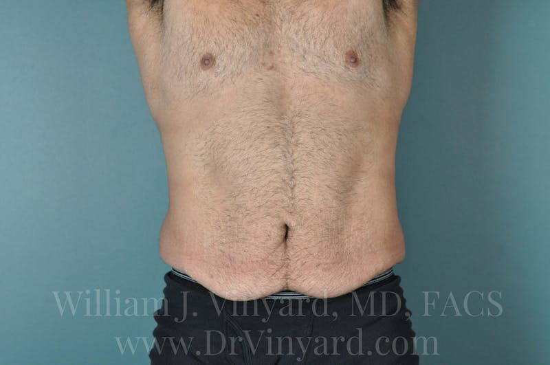 Lower Body Lift Before & After Gallery - Patient 169817675 - Image 1