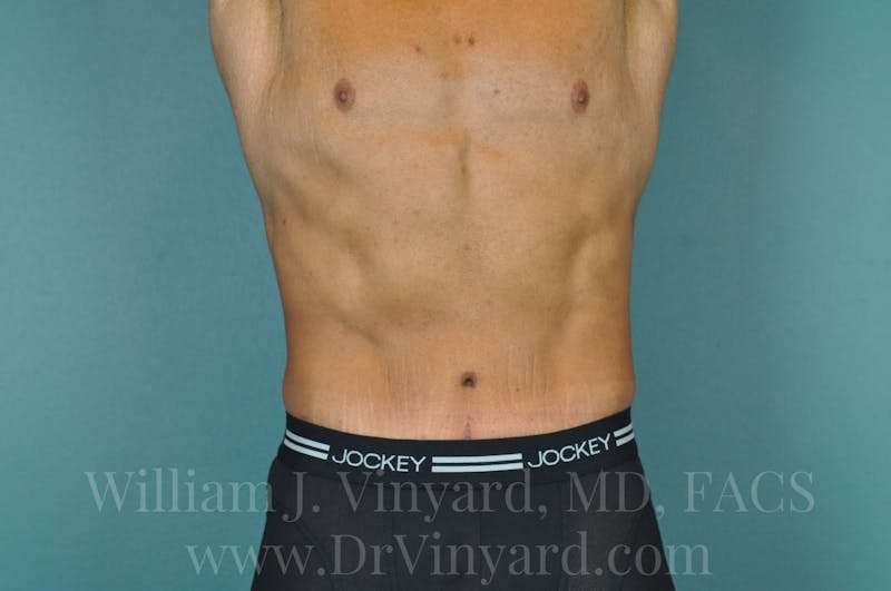 Lower Body Lift Before & After Gallery - Patient 169817675 - Image 2