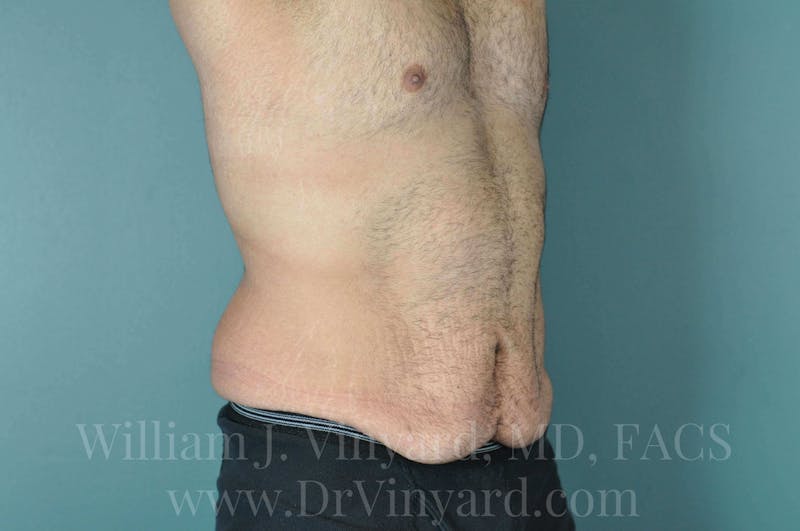 Lower Body Lift Before & After Gallery - Patient 169817675 - Image 3