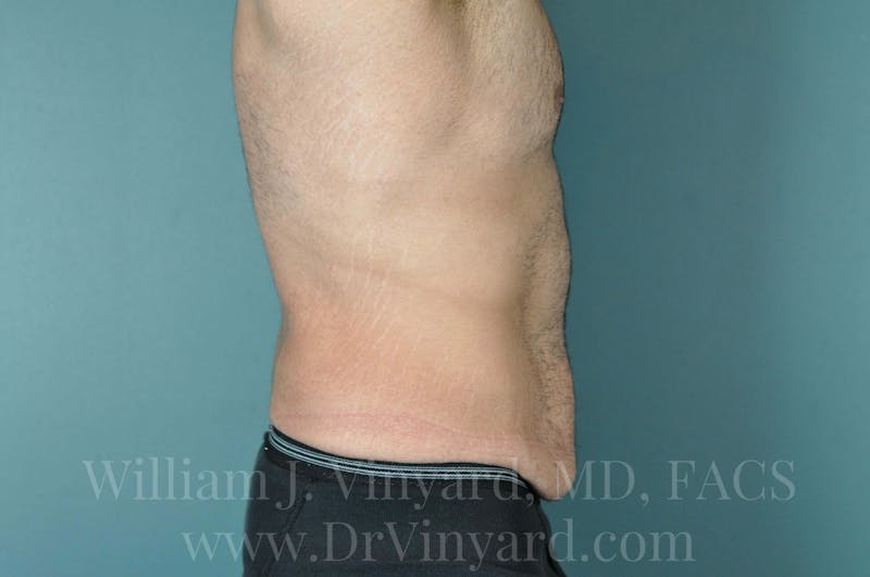Lower Body Lift Before & After Gallery - Patient 169817675 - Image 5