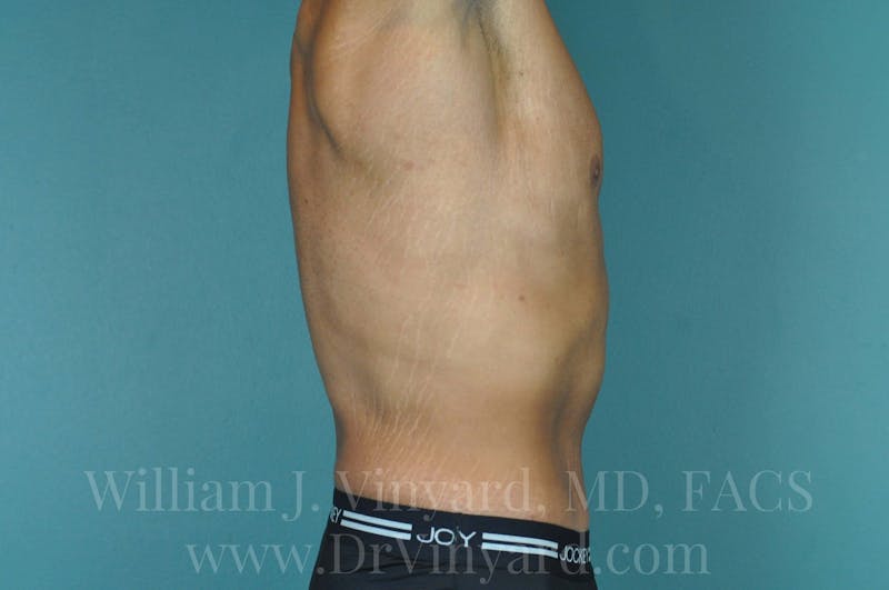 Lower Body Lift Before & After Gallery - Patient 169817675 - Image 6