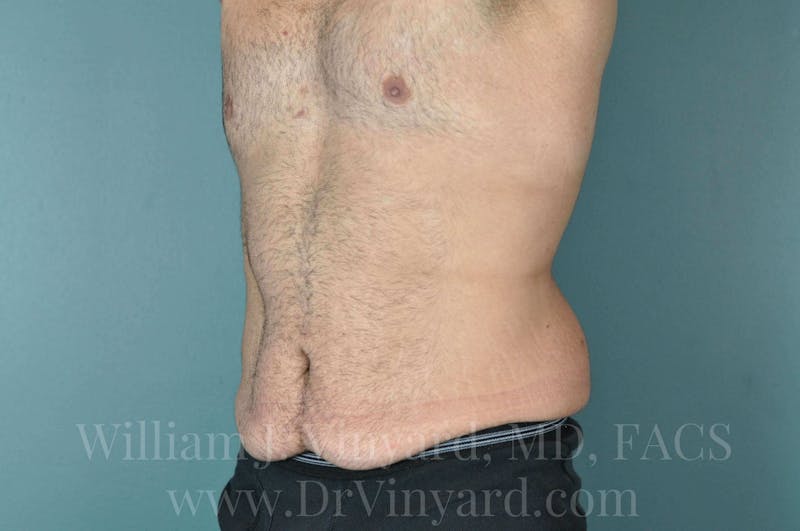 Lower Body Lift Before & After Gallery - Patient 169817675 - Image 7