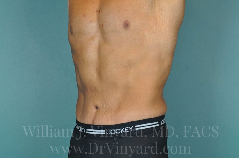 Lower Body Lift Before & After Gallery - Patient 169817675 - Image 8