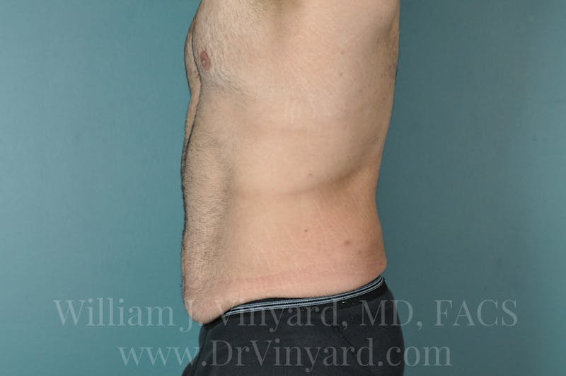 Lower Body Lift Before & After Gallery - Patient 169817675 - Image 9