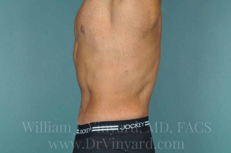 Lower Body Lift Before & After Gallery - Patient 169817675 - Image 10