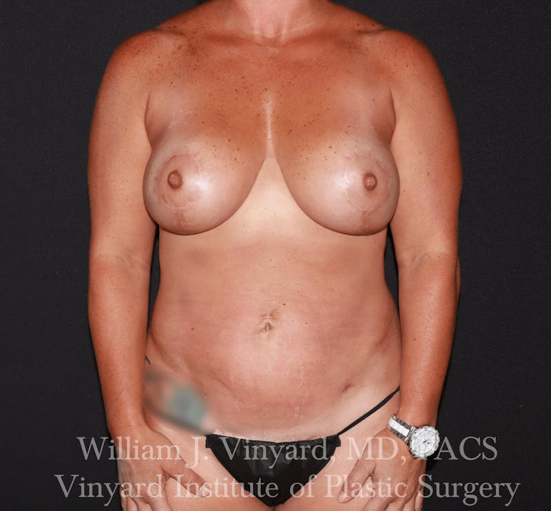 Mommy Makeover Before & After Gallery - Patient 169838229 - Image 2