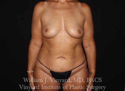 Mommy Makeover Before & After Gallery - Patient 169838232 - Image 1