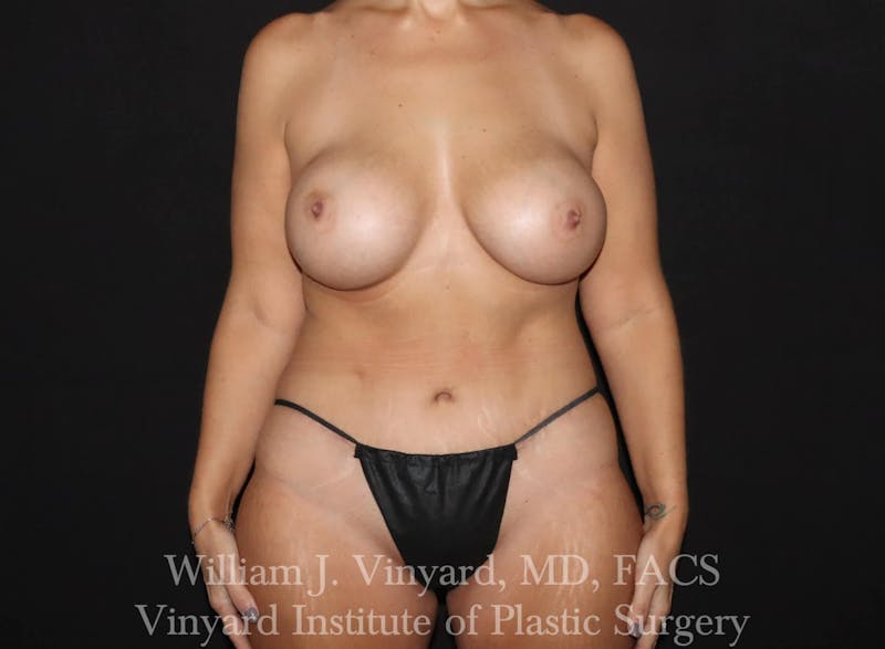 Mommy Makeover Before & After Gallery - Patient 169838232 - Image 2