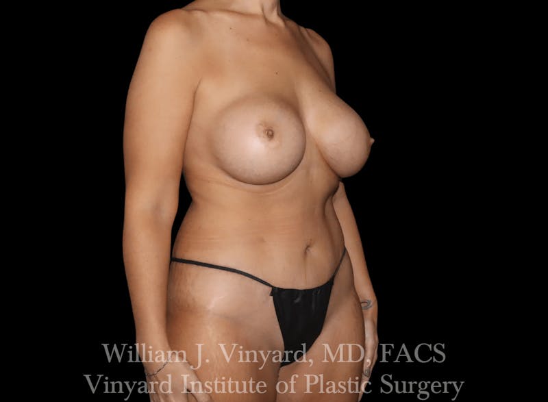 Mommy Makeover Before & After Gallery - Patient 169838232 - Image 4