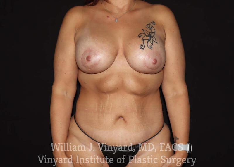 Mommy Makeover Before & After Gallery - Patient 169838233 - Image 2