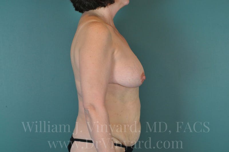 Mommy Makeover Before & After Gallery - Patient 169838772 - Image 5