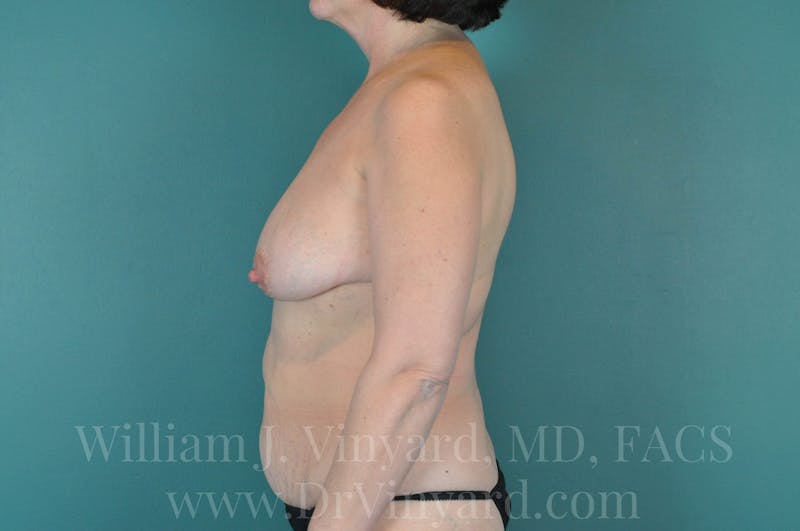 Mommy Makeover Before & After Gallery - Patient 169838772 - Image 9