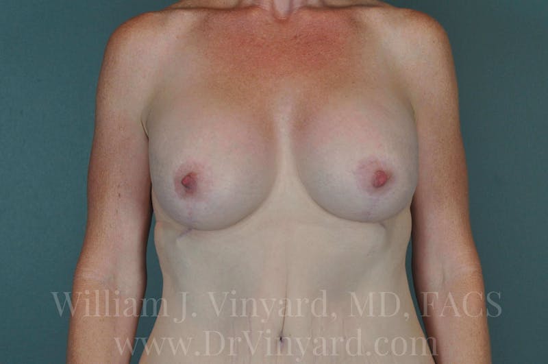 Mommy Makeover Before & After Gallery - Patient 169838784 - Image 2