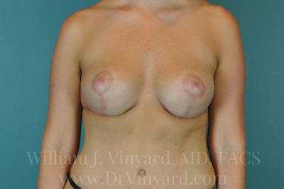 Mommy Makeover Before & After Gallery - Patient 169839219 - Image 2