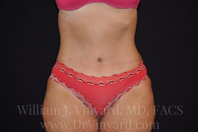 Mommy Makeover Before & After Gallery - Patient 169839332 - Image 2