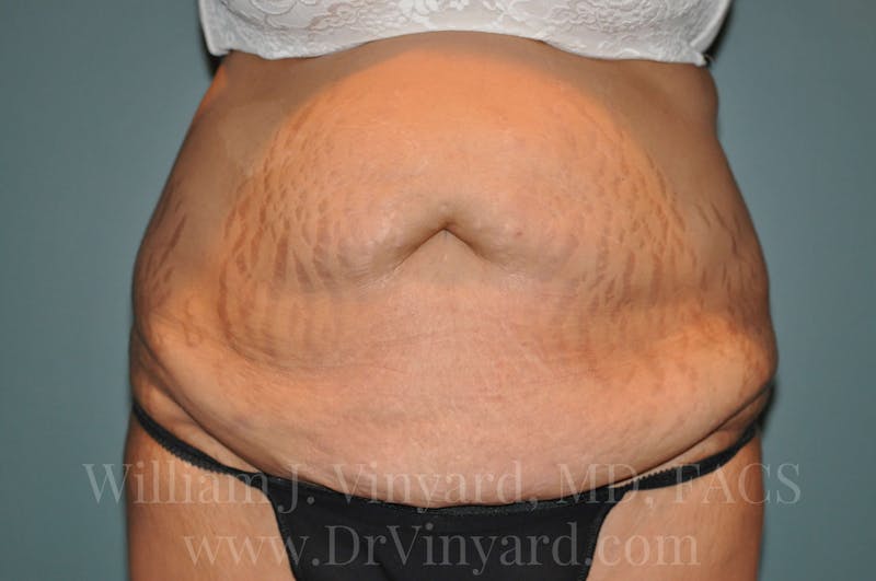Mommy Makeover Before & After Gallery - Patient 169839333 - Image 1