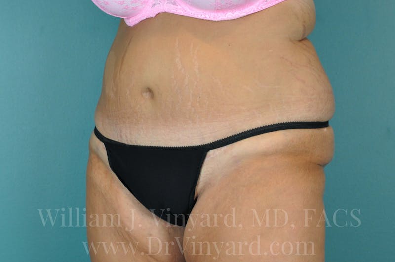 Mommy Makeover Before & After Gallery - Patient 169839333 - Image 8