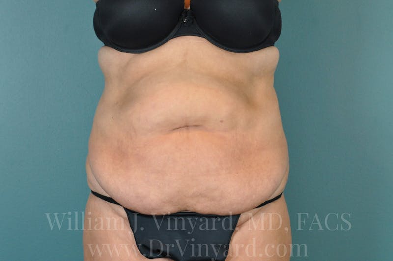 Mommy Makeover Before & After Gallery - Patient 169941181 - Image 1