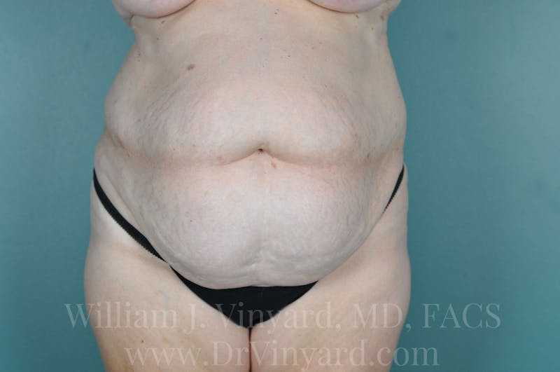 Mommy Makeover Before & After Gallery - Patient 169941187 - Image 1