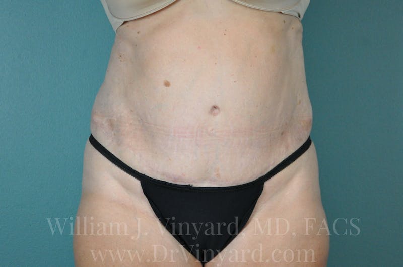 Mommy Makeover Before & After Gallery - Patient 169941187 - Image 2