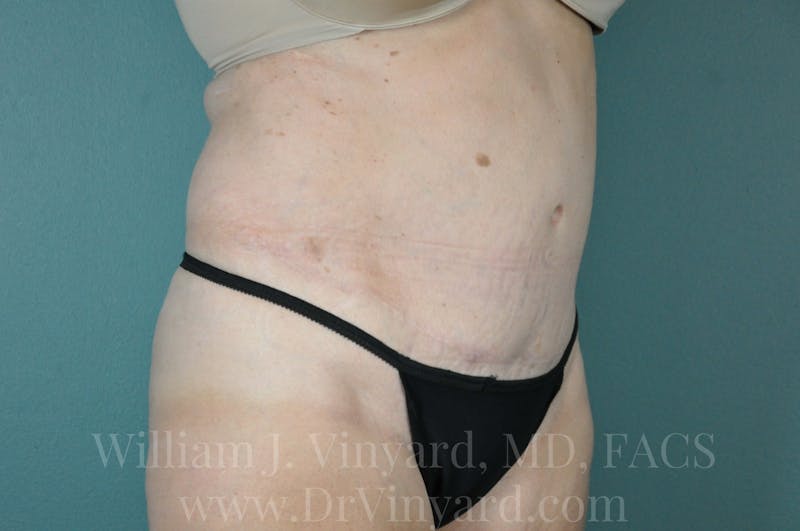 Mommy Makeover Before & After Gallery - Patient 169941187 - Image 4