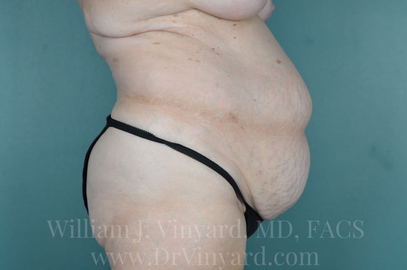 Mommy Makeover Before & After Gallery - Patient 169941187 - Image 5