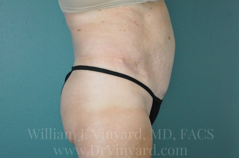 Mommy Makeover Before & After Gallery - Patient 169941187 - Image 6