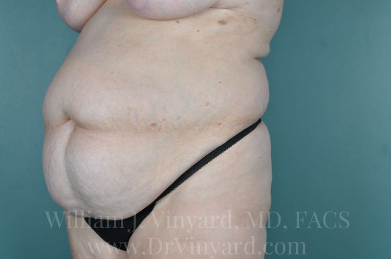 Mommy Makeover Before & After Gallery - Patient 169941187 - Image 7