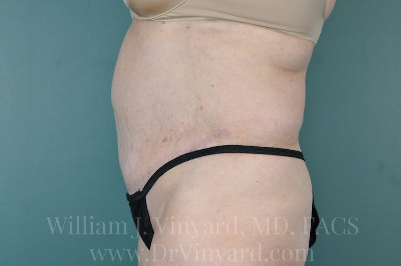 Mommy Makeover Before & After Gallery - Patient 169941187 - Image 10