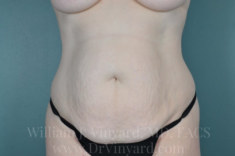 Mommy Makeover Before & After Gallery - Patient 169941527 - Image 1