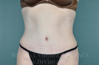 Mommy Makeover Before & After Gallery - Patient 169941527 - Image 2
