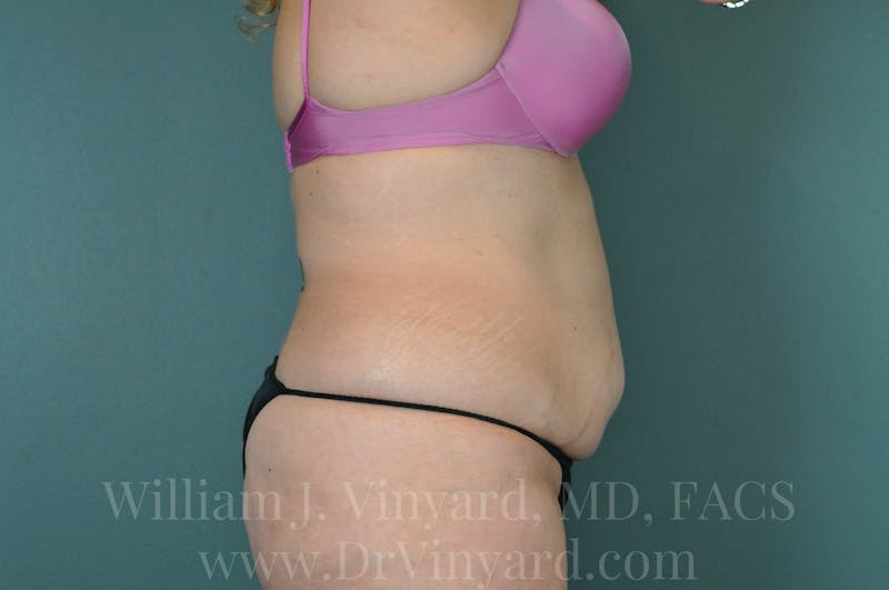 Mommy Makeover Before & After Gallery - Patient 169941696 - Image 5