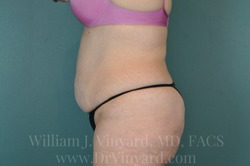 Mommy Makeover Before & After Gallery - Patient 169941696 - Image 9