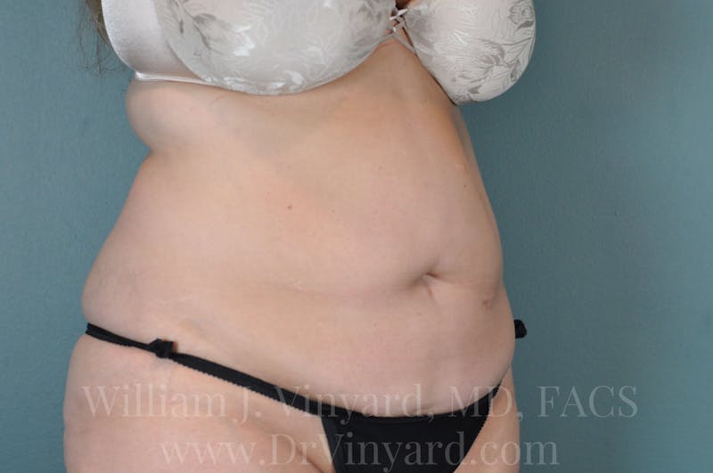 Mommy Makeover Before & After Gallery - Patient 169941699 - Image 3