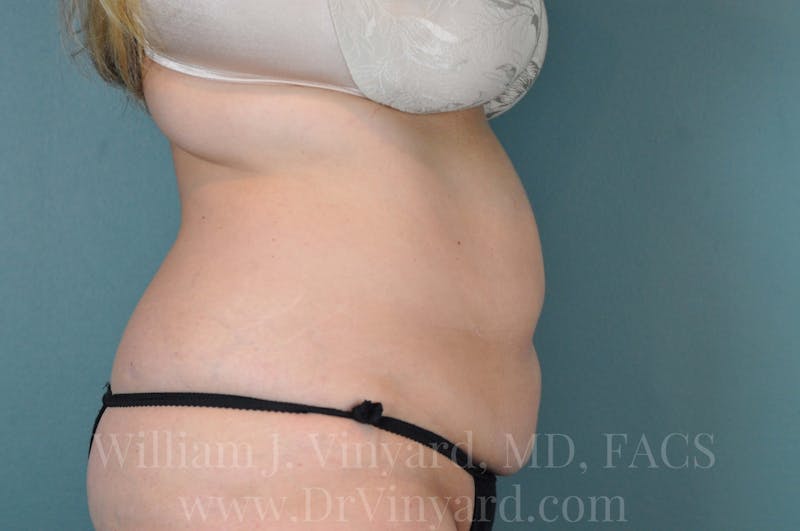 Mommy Makeover Before & After Gallery - Patient 169941699 - Image 5