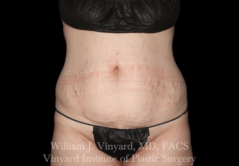 Tummy Tuck Before & After Gallery - Patient 169942231 - Image 1