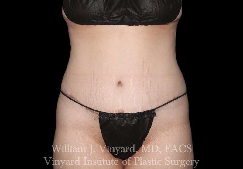 Tummy Tuck Before & After Gallery - Patient 169942231 - Image 2