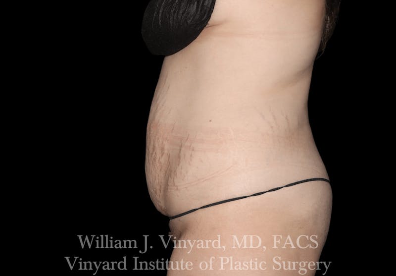 Tummy Tuck Before & After Gallery - Patient 169942231 - Image 3