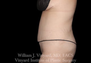 Tummy Tuck Before & After Gallery - Patient 169942231 - Image 4
