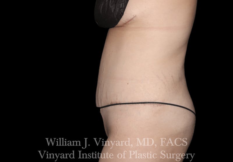 Tummy Tuck Before & After Gallery - Patient 169942231 - Image 4