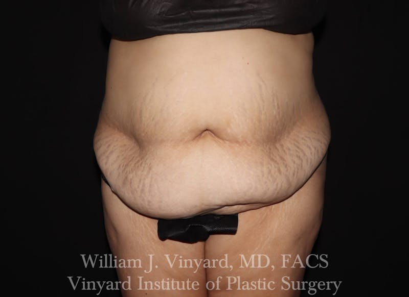 Tummy Tuck Before & After Gallery - Patient 169942238 - Image 1