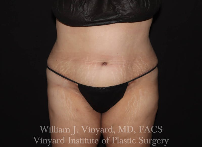 Tummy Tuck Before & After Gallery - Patient 169942238 - Image 2